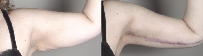 Upper Arm Rejuvenation Case 1316 Before & After Left Side | Paramus, New Jersey | Parker Center for Plastic Surgery