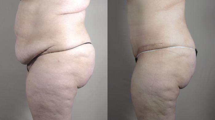 Upper Arm Rejuvenation Case 1316 Before & After side tt | Paramus, New Jersey | Parker Center for Plastic Surgery