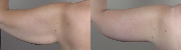 Upper Arm Rejuvenation Case 1320 Before & After Back | Paramus, New Jersey | Parker Center for Plastic Surgery