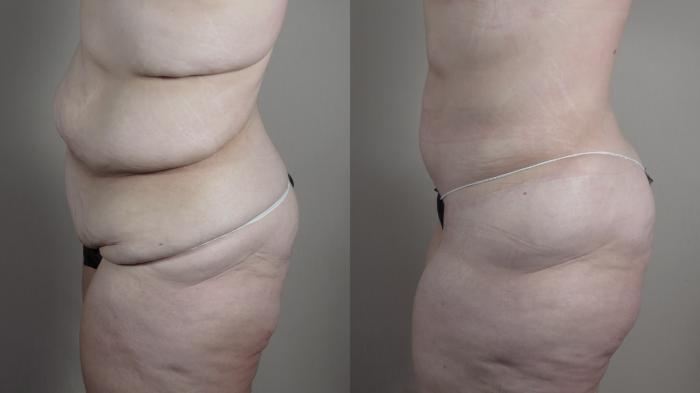 Upper Arm Rejuvenation Case 1320 Before & After left side | Paramus, New Jersey | Parker Center for Plastic Surgery