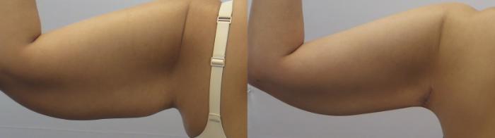 Upper Arm Rejuvenation Case 1649 Before & After front 1 | Paramus, New Jersey | Parker Center for Plastic Surgery