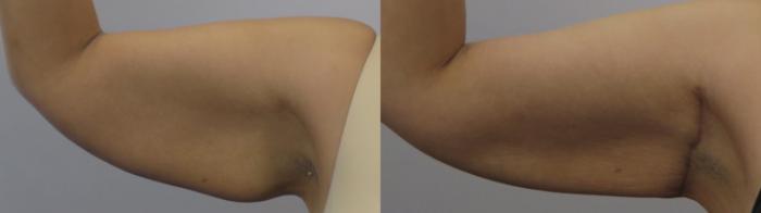 Upper Arm Rejuvenation Case 1649 Before & After Left Side | Paramus, New Jersey | Parker Center for Plastic Surgery