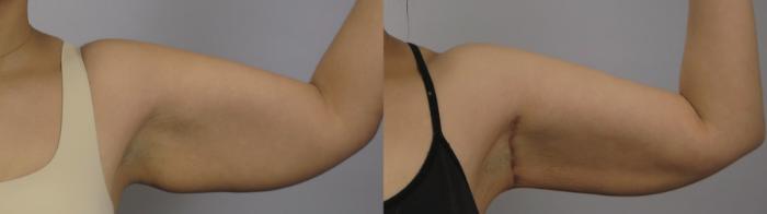 Upper Arm Rejuvenation Case 1649 Before & After Right Side | Paramus, New Jersey | Parker Center for Plastic Surgery