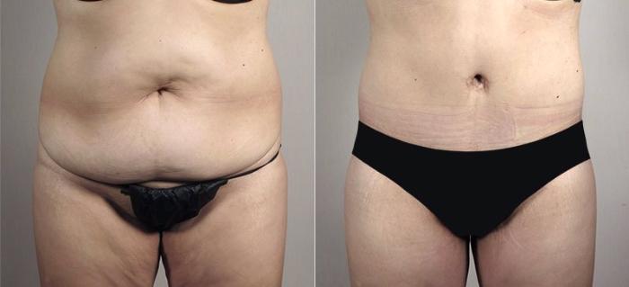 Upper Arm Rejuvenation Case 558 Before & After View #1 | Paramus, New Jersey | Parker Center for Plastic Surgery