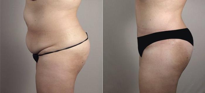 Upper Arm Rejuvenation Case 558 Before & After View #3 | Paramus, New Jersey | Parker Center for Plastic Surgery