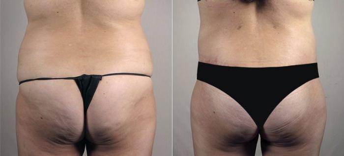 Upper Arm Rejuvenation Case 558 Before & After View #4 | Paramus, New Jersey | Parker Center for Plastic Surgery