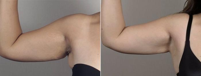 Upper Arm Rejuvenation Case 558 Before & After View #5 | Paramus, New Jersey | Parker Center for Plastic Surgery