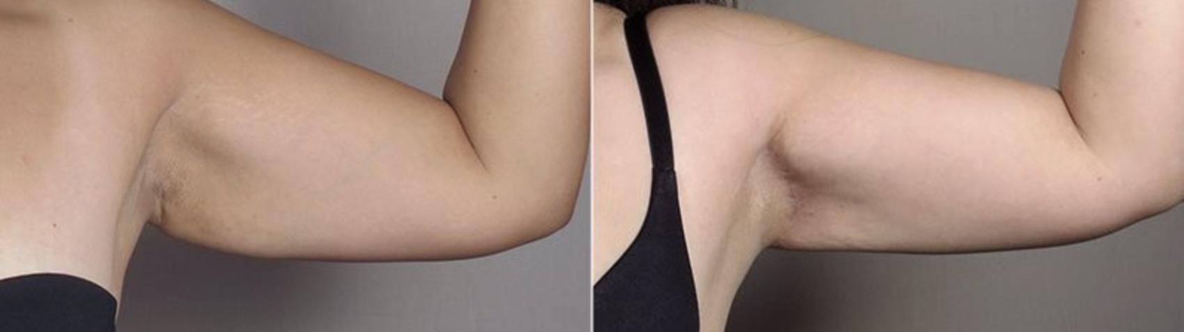 Upper Arm Rejuvenation Case 558 Before & After View #6 | Paramus, New Jersey | Parker Center for Plastic Surgery