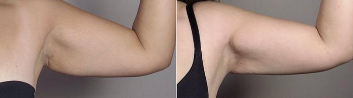 Upper Arm Rejuvenation Case 558 Before & After View #6 | Paramus, New Jersey | Parker Center for Plastic Surgery