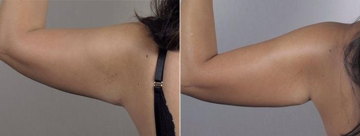 Upper Arm Rejuvenation Case 558 Before & After View #7 | Paramus, New Jersey | Parker Center for Plastic Surgery