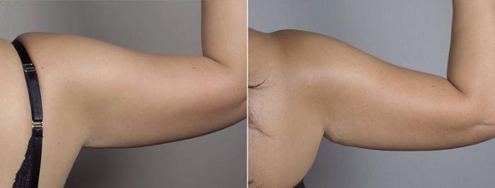 Upper Arm Rejuvenation Case 558 Before & After View #8 | Paramus, New Jersey | Parker Center for Plastic Surgery