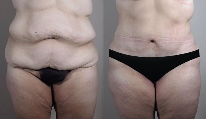 Upper Arm Rejuvenation Case 749 Before & After View #1 | Paramus, New Jersey | Parker Center for Plastic Surgery