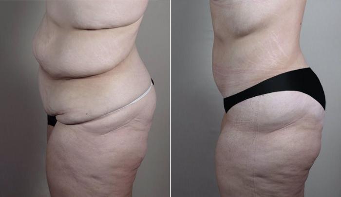 Upper Arm Rejuvenation Case 749 Before & After View #2 | Paramus, New Jersey | Parker Center for Plastic Surgery