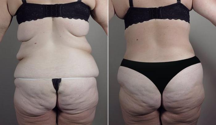 Upper Arm Rejuvenation Case 749 Before & After View #3 | Paramus, New Jersey | Parker Center for Plastic Surgery