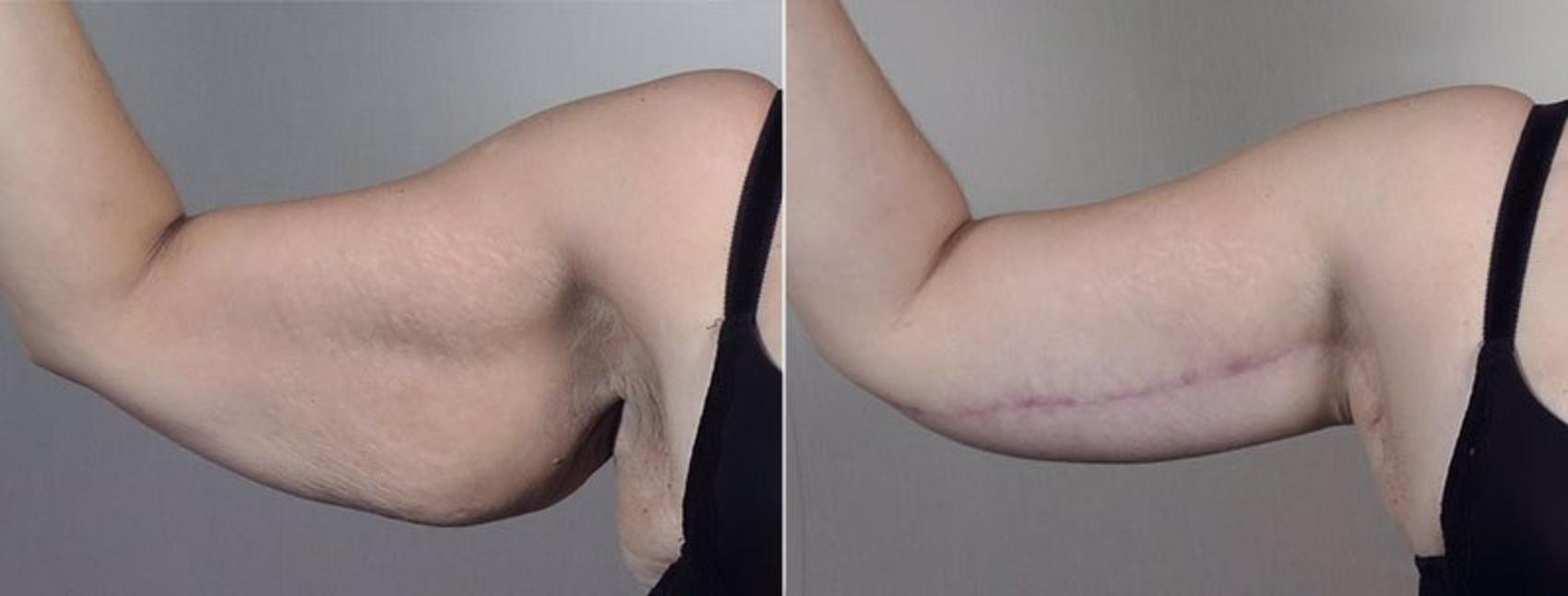 Upper Arm Rejuvenation Case 749 Before & After View #4 | Paramus, New Jersey | Parker Center for Plastic Surgery