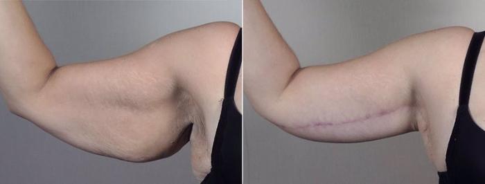 Upper Arm Rejuvenation Case 749 Before & After View #4 | Paramus, New Jersey | Parker Center for Plastic Surgery