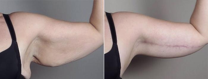 Upper Arm Rejuvenation Case 749 Before & After View #5 | Paramus, New Jersey | Parker Center for Plastic Surgery