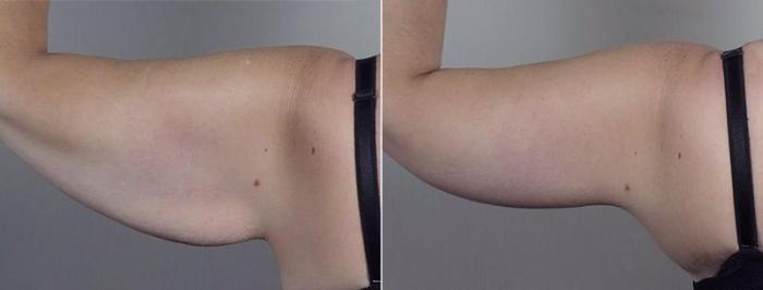 Upper Arm Rejuvenation Case 749 Before & After View #6 | Paramus, New Jersey | Parker Center for Plastic Surgery