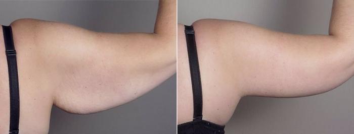 Upper Arm Rejuvenation Case 749 Before & After View #7 | Paramus, New Jersey | Parker Center for Plastic Surgery