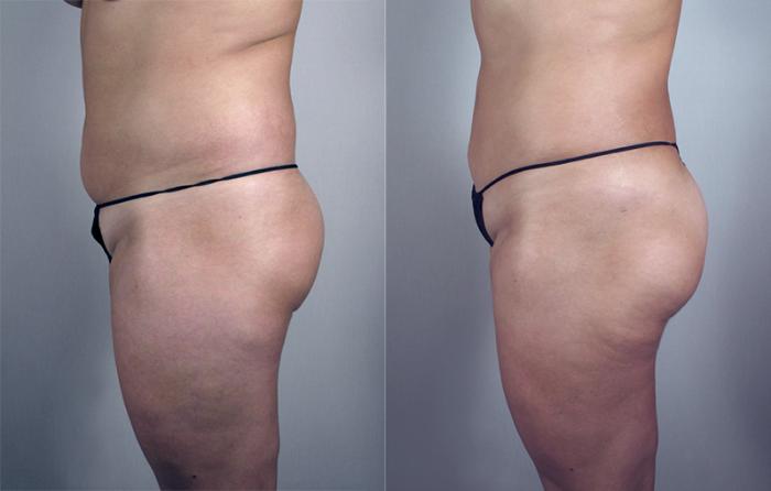 Upper Arm Rejuvenation Case 776 Before & After View #2 | Paramus, New Jersey | Parker Center for Plastic Surgery
