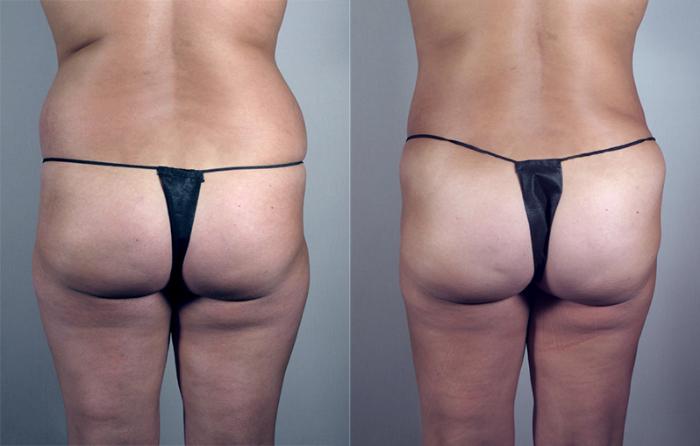 Upper Arm Rejuvenation Case 776 Before & After View #3 | Paramus, New Jersey | Parker Center for Plastic Surgery
