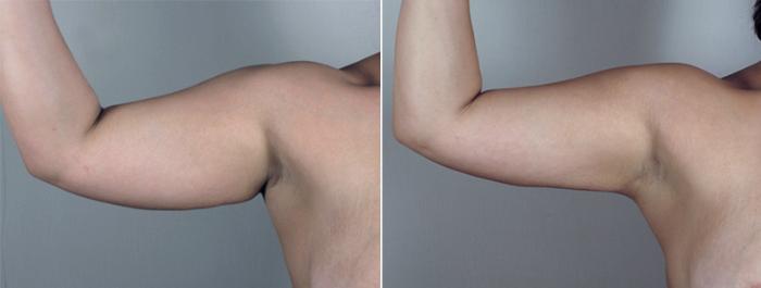 Upper Arm Rejuvenation Case 776 Before & After View #4 | Paramus, New Jersey | Parker Center for Plastic Surgery