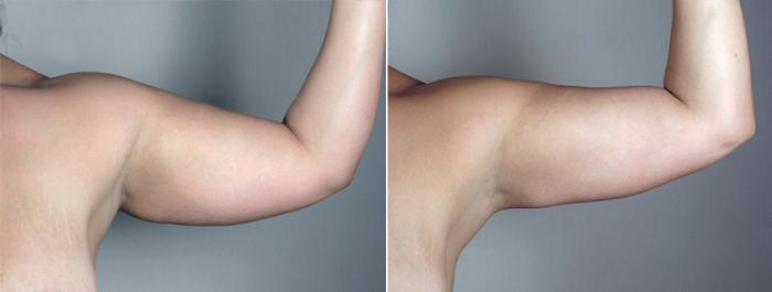 Upper Arm Rejuvenation Case 776 Before & After View #5 | Paramus, New Jersey | Parker Center for Plastic Surgery
