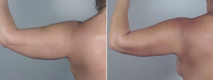 Upper Arm Rejuvenation Case 776 Before & After View #6 | Paramus, New Jersey | Parker Center for Plastic Surgery