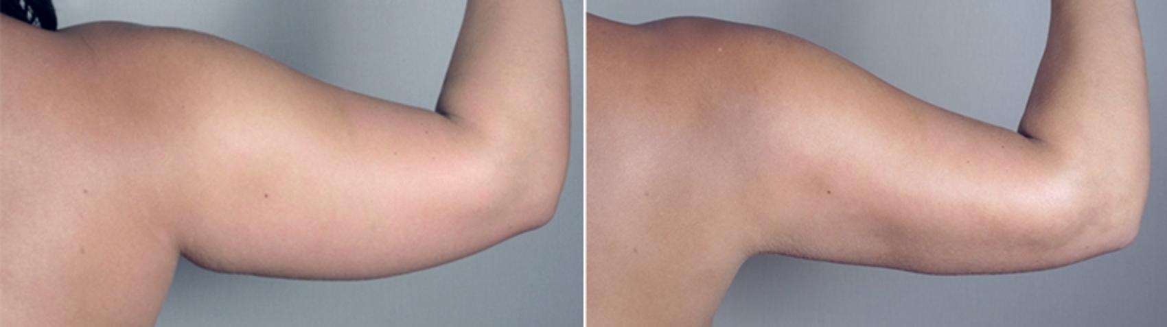 Upper Arm Rejuvenation Case 776 Before & After View #7 | Paramus, New Jersey | Parker Center for Plastic Surgery