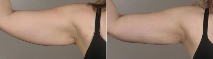 Upper Arm Rejuvenation Case 803 Before & After View #1 | Paramus, New Jersey | Parker Center for Plastic Surgery
