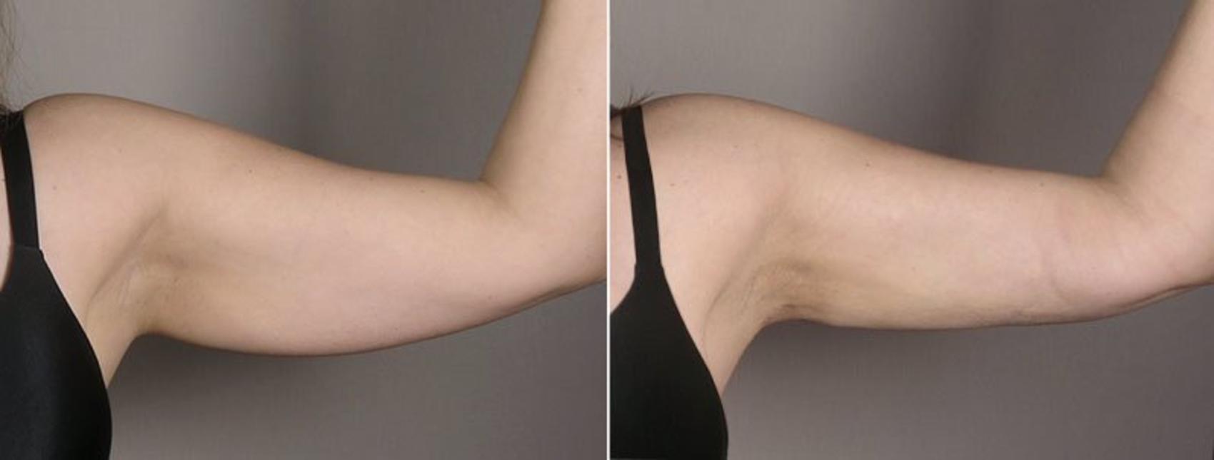 Upper Arm Rejuvenation Case 803 Before & After View #2 | Paramus, New Jersey | Parker Center for Plastic Surgery