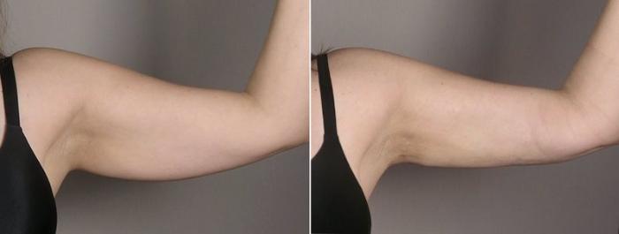 Upper Arm Rejuvenation Case 803 Before & After View #2 | Paramus, New Jersey | Parker Center for Plastic Surgery