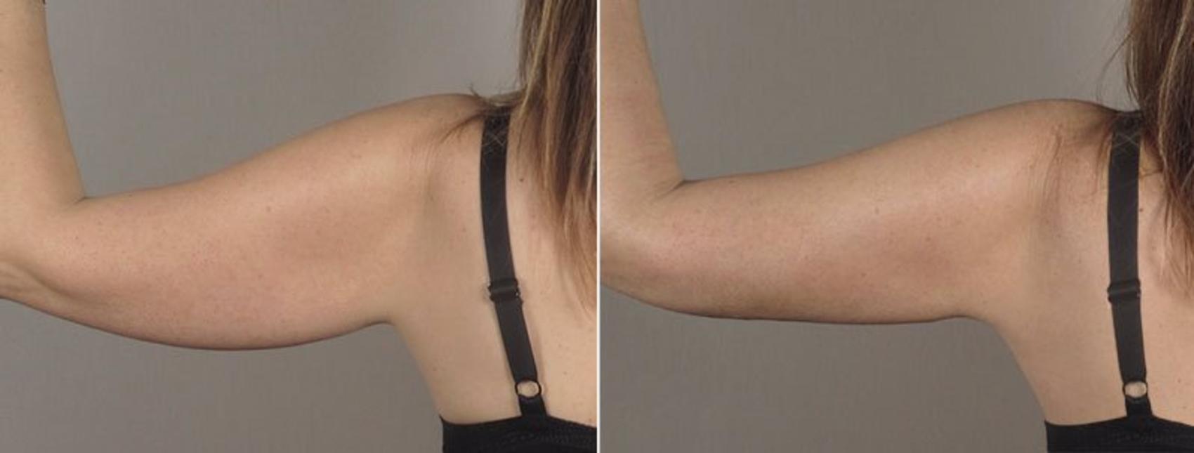 Upper Arm Rejuvenation Case 803 Before & After View #3 | Paramus, New Jersey | Parker Center for Plastic Surgery