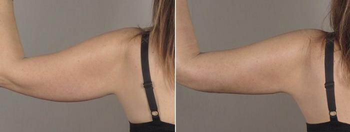 Upper Arm Rejuvenation Case 803 Before & After View #3 | Paramus, New Jersey | Parker Center for Plastic Surgery