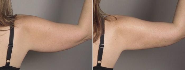 Upper Arm Rejuvenation Case 803 Before & After View #4 | Paramus, New Jersey | Parker Center for Plastic Surgery