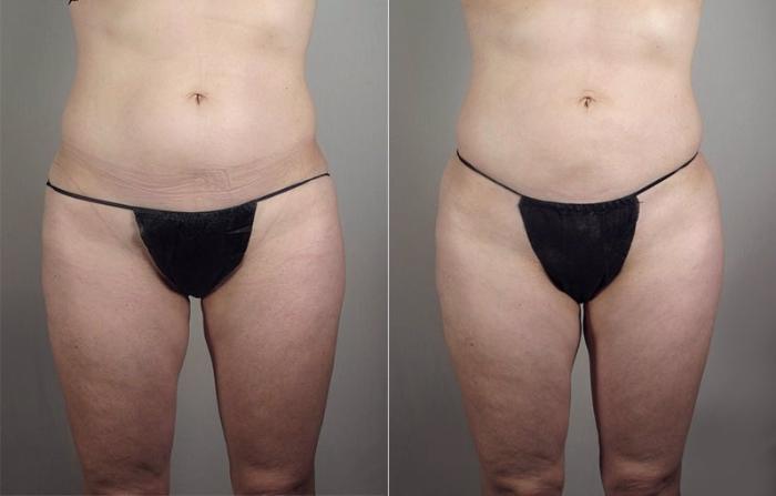 Upper Arm Rejuvenation Case 803 Before & After View #5 | Paramus, New Jersey | Parker Center for Plastic Surgery