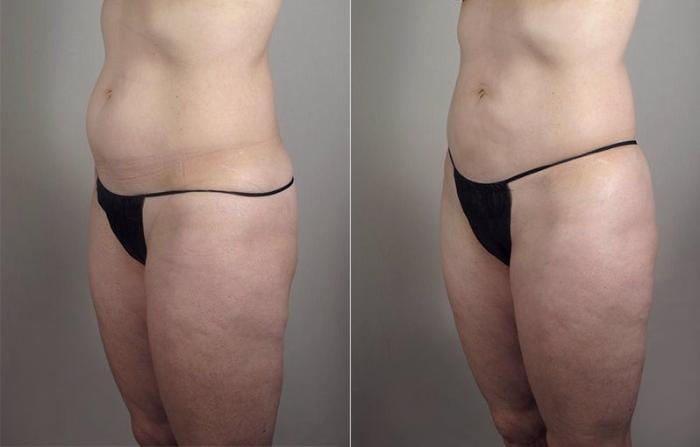 Upper Arm Rejuvenation Case 803 Before & After View #6 | Paramus, New Jersey | Parker Center for Plastic Surgery