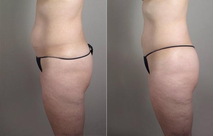 Upper Arm Rejuvenation Case 803 Before & After View #7 | Paramus, New Jersey | Parker Center for Plastic Surgery