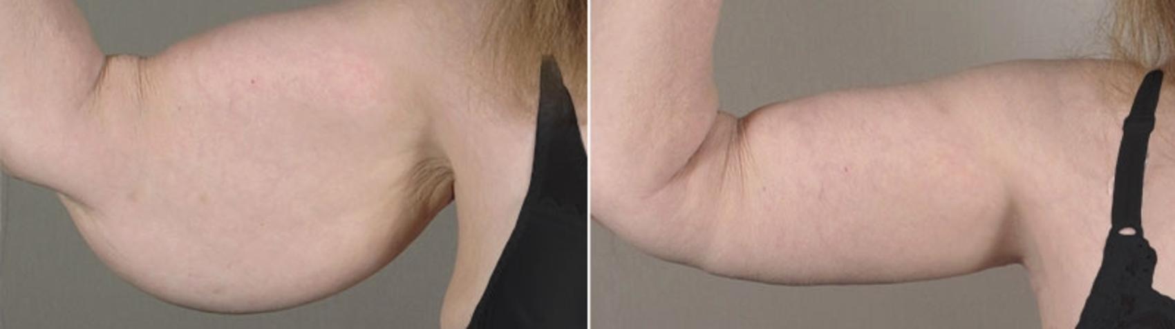 Upper Arm Rejuvenation Case 821 Before & After View #1 | Paramus, New Jersey | Parker Center for Plastic Surgery