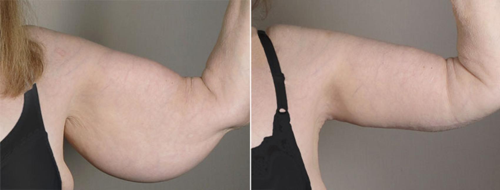 Upper Arm Rejuvenation Case 821 Before & After View #2 | Paramus, New Jersey | Parker Center for Plastic Surgery