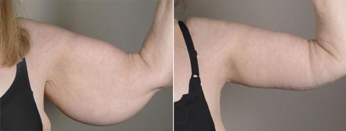 Upper Arm Rejuvenation Case 821 Before & After View #2 | Paramus, New Jersey | Parker Center for Plastic Surgery