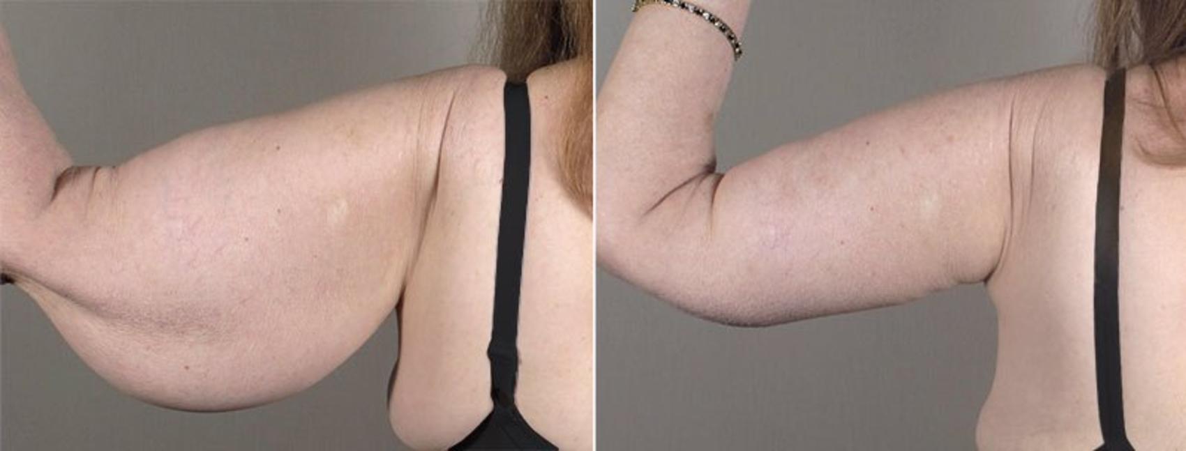 Upper Arm Rejuvenation Case 821 Before & After View #3 | Paramus, New Jersey | Parker Center for Plastic Surgery