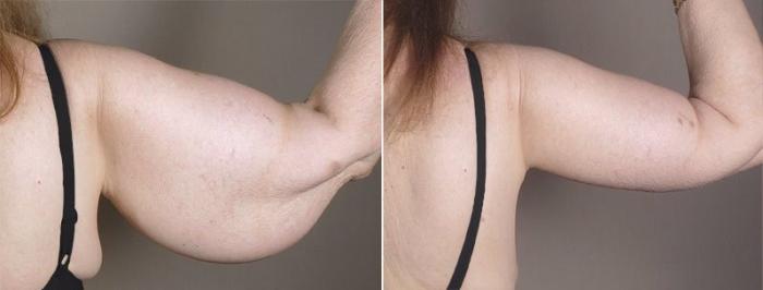 Upper Arm Rejuvenation Case 821 Before & After View #4 | Paramus, New Jersey | Parker Center for Plastic Surgery
