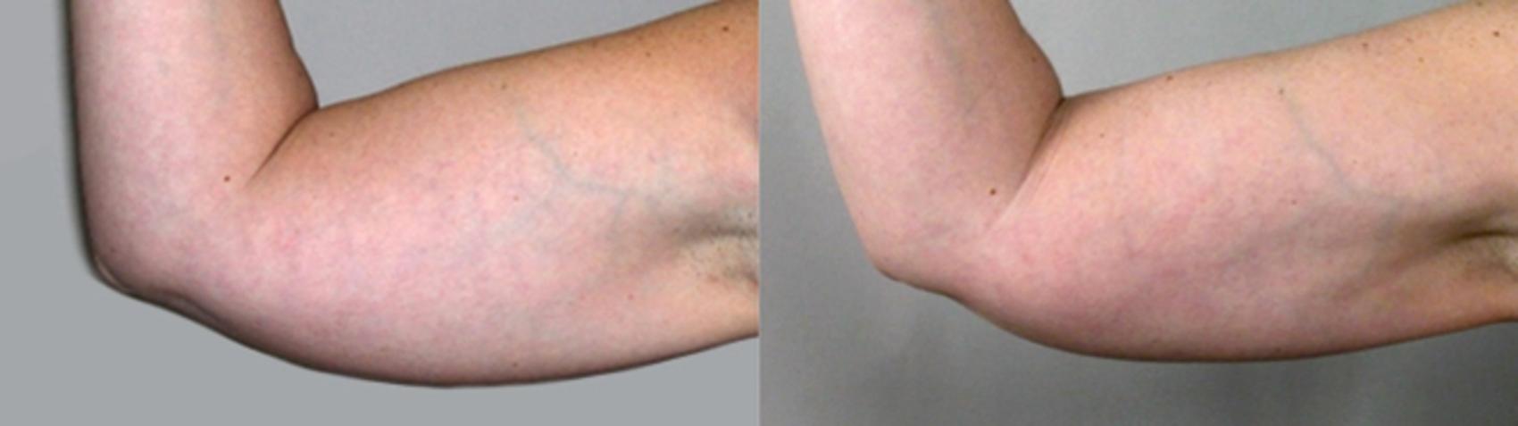 Upper Arm Rejuvenation Case 822 Before & After View #1 | Paramus, New Jersey | Parker Center for Plastic Surgery