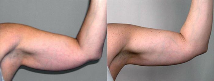 Upper Arm Rejuvenation Case 822 Before & After View #2 | Paramus, New Jersey | Parker Center for Plastic Surgery