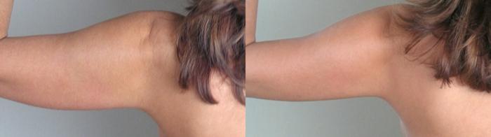 Upper Arm Rejuvenation Case 823 Before & After View #1 | Paramus, New Jersey | Parker Center for Plastic Surgery