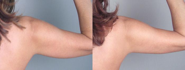 Upper Arm Rejuvenation Case 823 Before & After View #2 | Paramus, New Jersey | Parker Center for Plastic Surgery