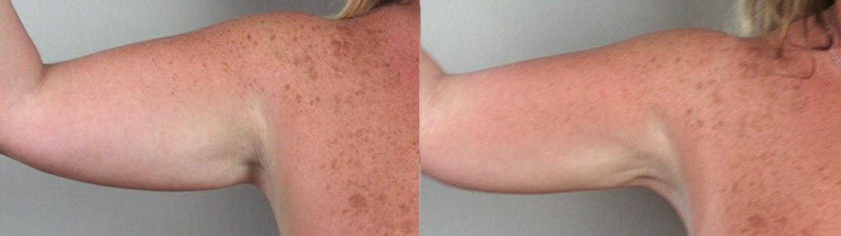 Upper Arm Rejuvenation Case 824 Before & After View #1 | Paramus, New Jersey | Parker Center for Plastic Surgery