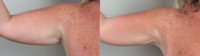 Upper Arm Rejuvenation Case 824 Before & After View #1 | Paramus, New Jersey | Parker Center for Plastic Surgery