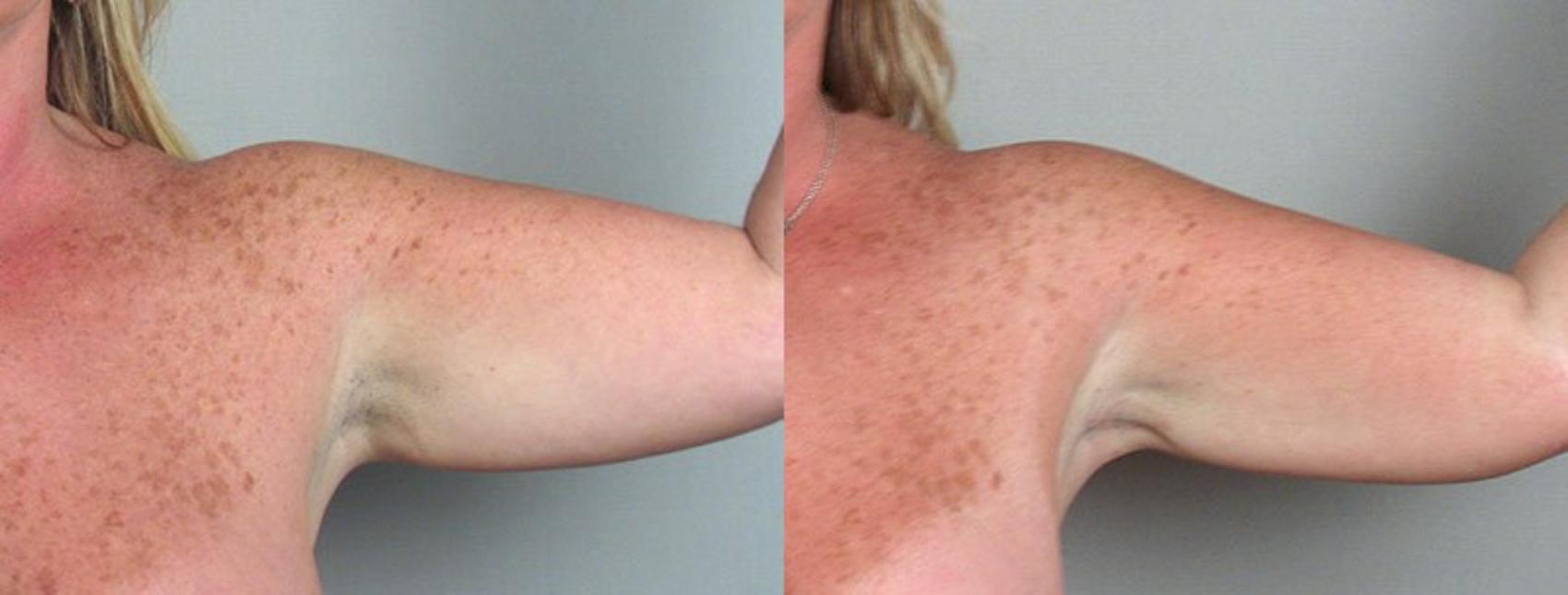 Upper Arm Rejuvenation Case 824 Before & After View #2 | Paramus, New Jersey | Parker Center for Plastic Surgery